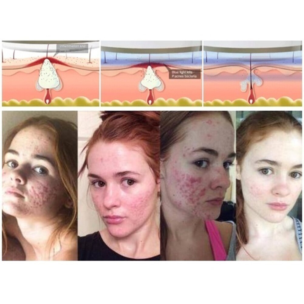 Lase Freckle Dark Spot Scar Acne Removal Therapy Pen Medical Blue Light Portable Acne Laser Pen Scar Wrinkle Removal Beauty Tool
