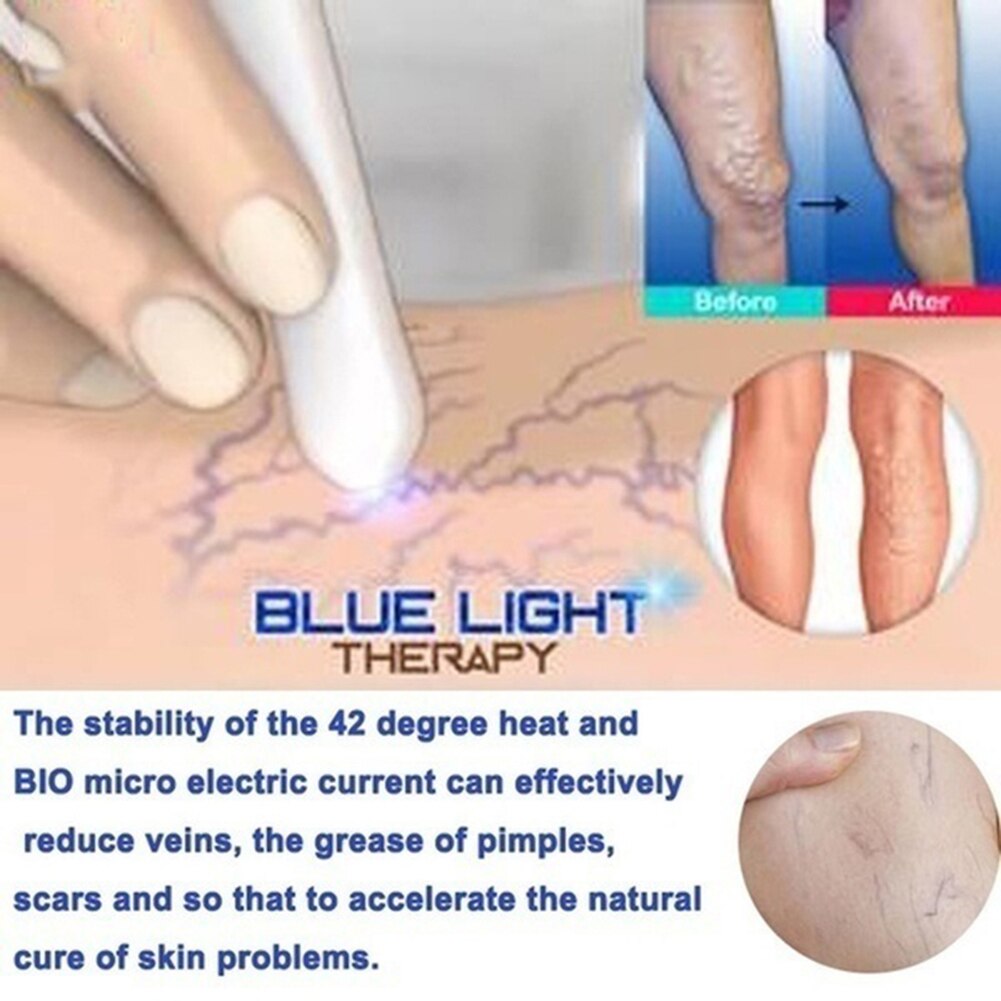 Lase Freckle Dark Spot Scar Acne Removal Therapy Pen Medical Blue Light Portable Acne Laser Pen Scar Wrinkle Removal Beauty Tool