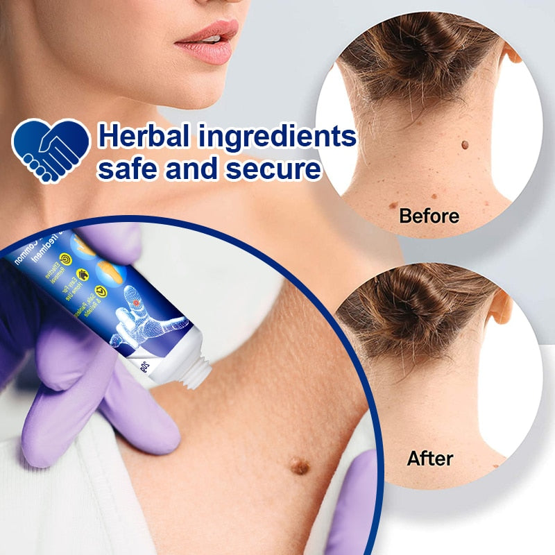 Sumifun Warts Remover Ointment Antibacterial Wart Treatment Cream Skin Tags Removing Genital Warts Herpes Medical Plaster