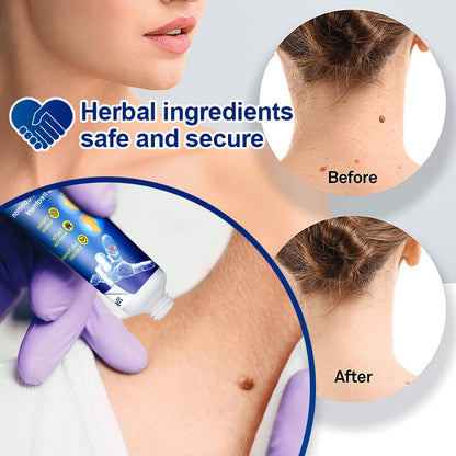Sumifun Warts Remover Ointment Antibacterial Wart Treatment Cream Skin Tags Removing Genital Warts Herpes Medical Plaster
